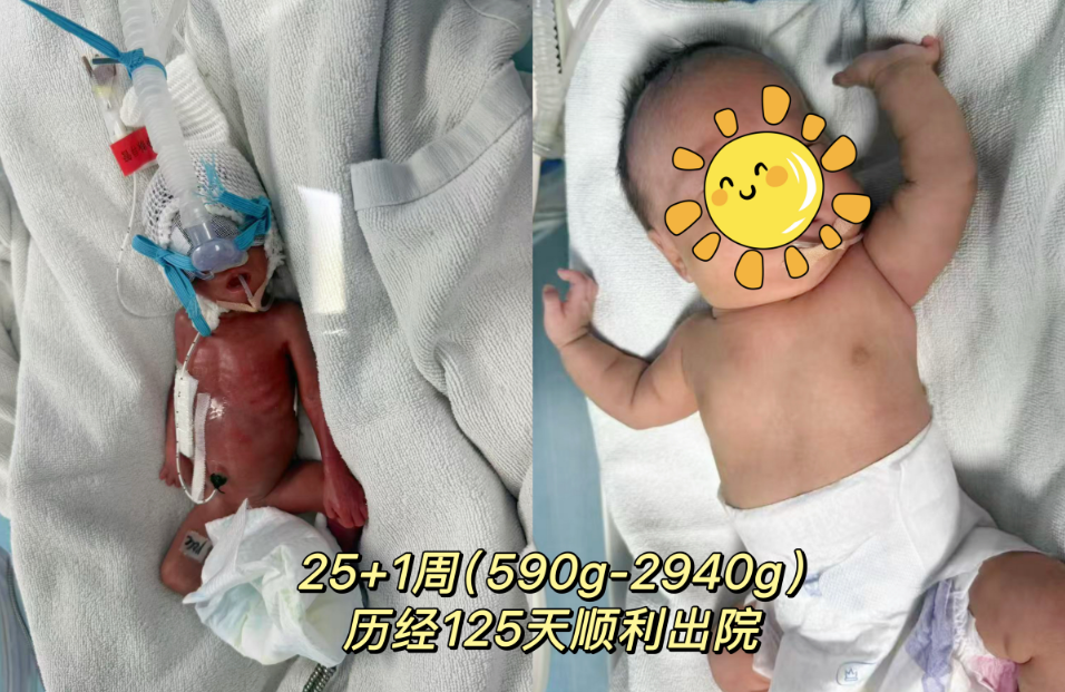生命奇跡再刷新！懷化市婦幼保健院成功救治 25 周 出生體重僅590g的“掌心寶寶”